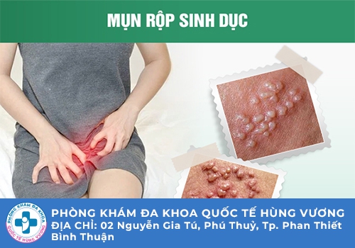 Nổi mụn âm đạo – Dấu hiệu cảnh báo nhiều bệnh lý nguy hiểm