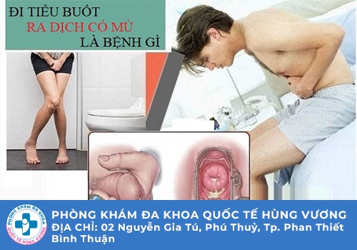Tiểu buốt ra mủ ở nam giới 