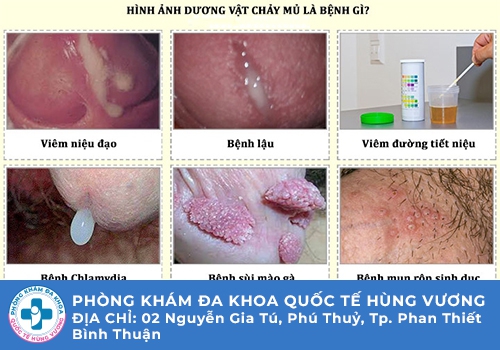Tiểu buốt chảy mủ là bệnh gì?