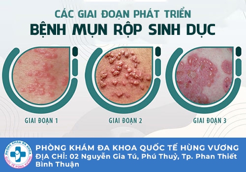 Nguyên nhân gây mụn Herpes ở miệng, môi