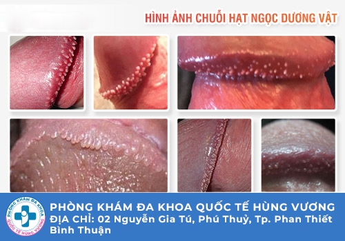 Chuỗi hạt ngọc dương vật là gì?