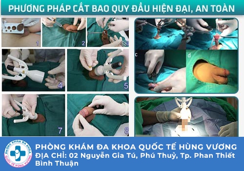 Điều trị chuỗi hạt ngọc dương vật thế nào hiệu quả