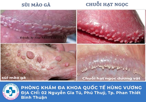 Hạt ngọc dương vật là gì