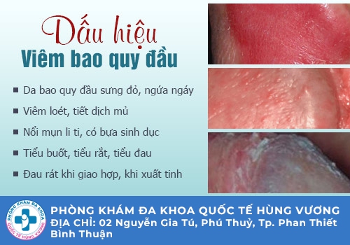 Những bệnh bao quy đầu thường gặp ở nam giới