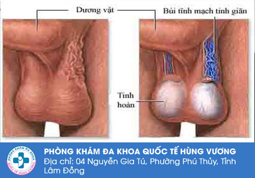 Hình ảnh về giãn tĩnh mạch tinh hoàn