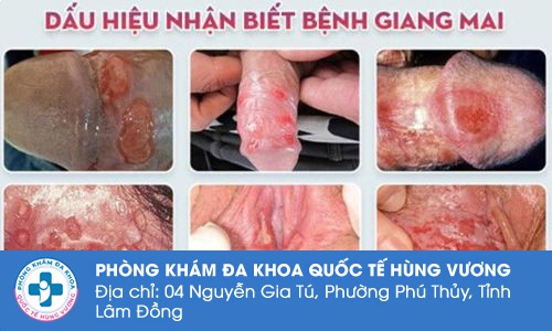 Hình ảnh bệnh giang mai. Bệnh quan hệ là gì?