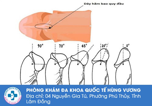 Tuỳ mỗi người sẽ có cấu tạo dây hãm bao quy đầu khác nhau