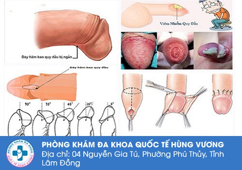 dương vật chảy máu