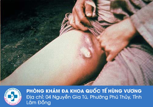 Nổi hạch ở lông mu có nguy hiểm không?