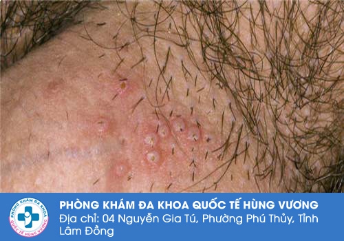 Hình ảnh về bệnh mụn rộp sinh dục