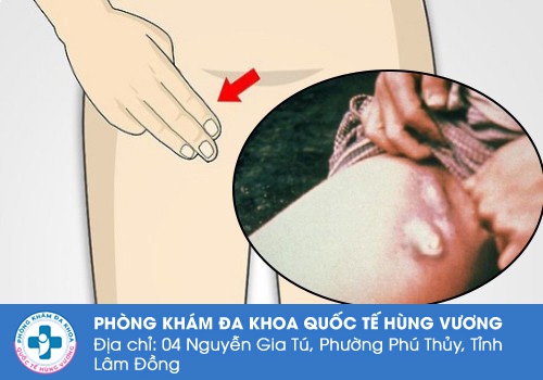 Nổi hạch ở bẹn có nguy hiểm không