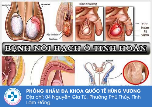 Nguyên nhân bệnh nổi hạch ở tinh hoàn