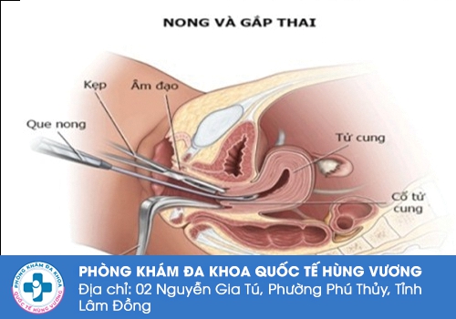 Phá thai 13 tuần bằng phương pháp nong gắp thai an toàn.