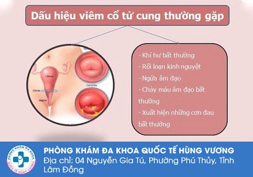 Dấu hiệu của viêm cổ tử cung.