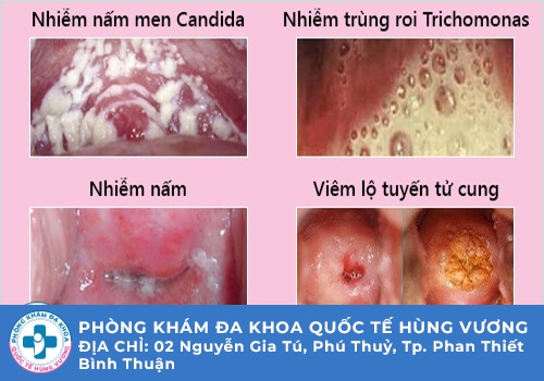 Nguyên nhân dẫn đến tình trạng huyết trắng bột