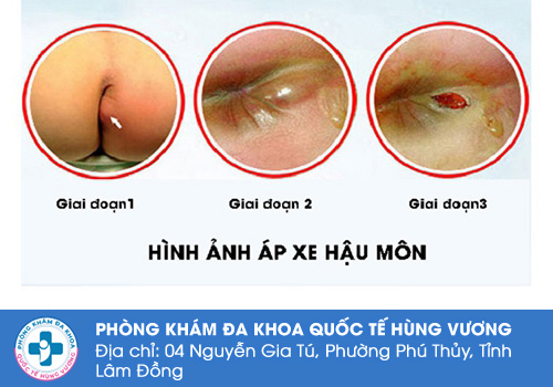  Biến chứng của áp xe hậu môn