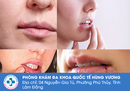 Mụn Herpes ở môi - miệng là gì?