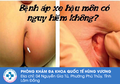 Áp xe hậu môn nguy hiểm như thế nào?