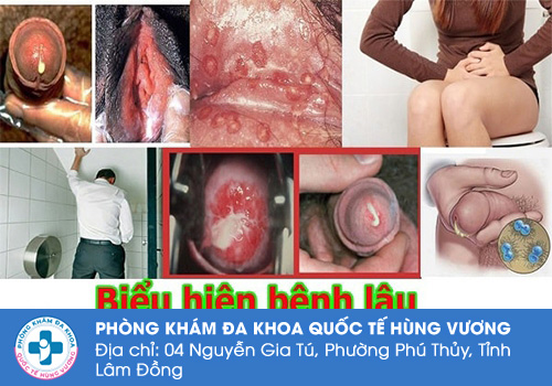 Chi phí điều trị bệnh lậu bao nhiêu tiền?