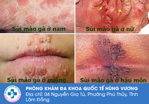 Giai đoạn phát triển của bệnh sùi mào gà
