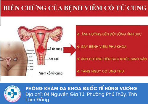 Viêm cổ tử cung và những biến chứng nguy hiểm　