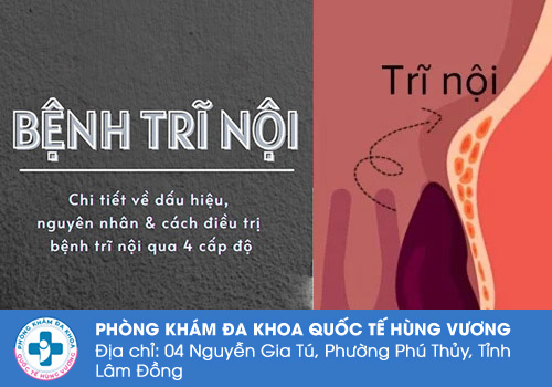 Tổng quan về bệnh trĩ nội