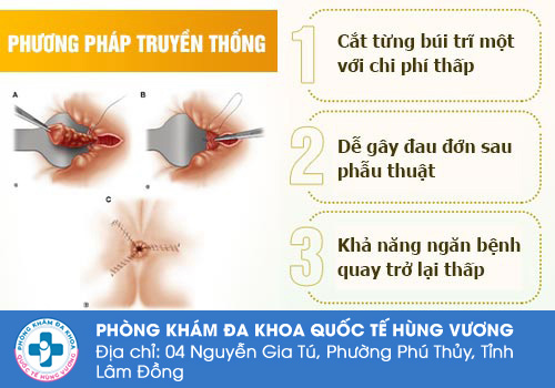 Thắt trĩ truyền thống