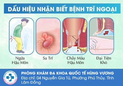Các dấu hiệu dễ nhận biết sa búi trĩ sau sinh