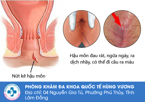 Triệu chứng của bệnh rách hậu môn