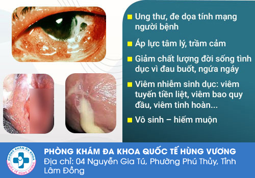Bệnh lậu có nguy hiểm không?