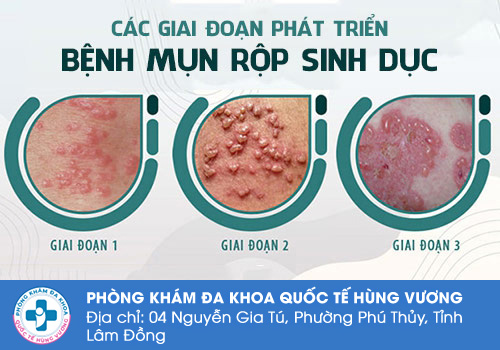 Mọc mụn nước âm đạo do bệnh mụn rộp sinh dục