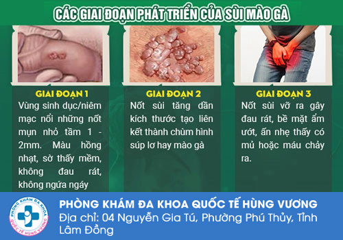Giai đoạn phát triển của bệnh sùi mào gà