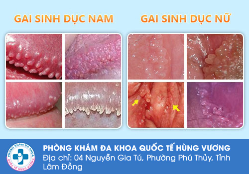 Nổi mụn nước vùng kín do gai sinh dục