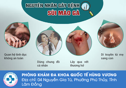 Nguyên nhân gây bệnh sùi mào gà ở nam giới