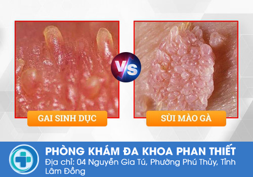 Chuỗi hạt ngọc dương vật có nguy hiểm không?