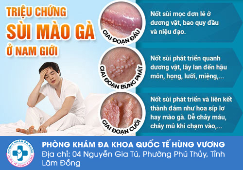 Triệu chứng, dấu hiệu bệnh sùi mào gà ở nam