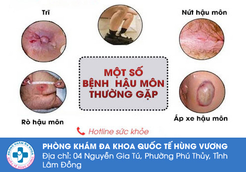 Các bệnh lý hậu môn trực tràng thường gặp