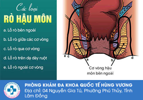 Nguyên nhân dẫn đến bệnh rò hậu môn