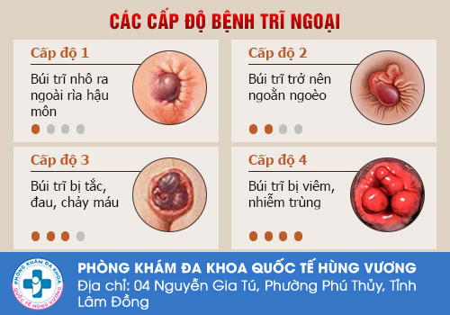 Các triệu chứng điển hình của bệnh trĩ ngoại độ 1