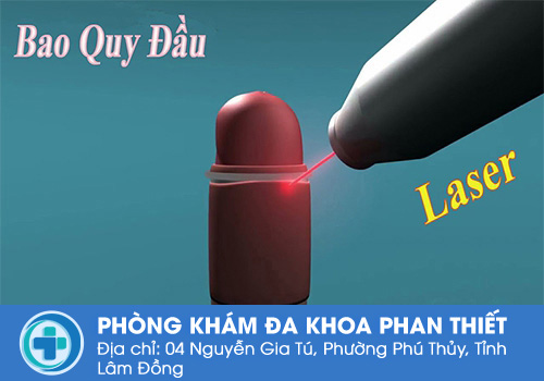 Phương pháp cắt bao quy đầu bằng laser