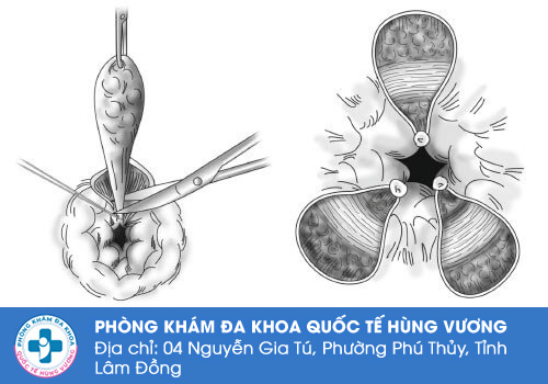 Cách trị sa búi trĩ hiệu quả, an toàn cao