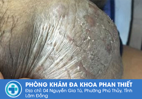 Bệnh chàm bìu có nguy hiểm không?