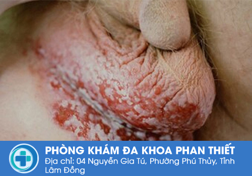 Triệu chứng chàm bìu ở nam giới như thế nào?