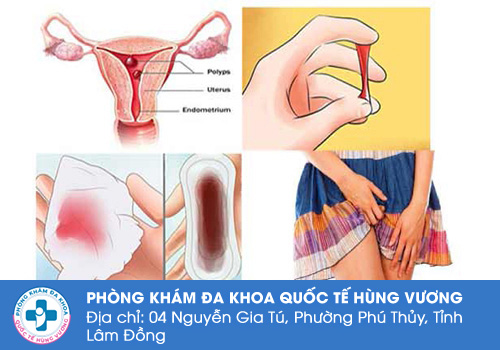 Chảy máu âm đạo nhưng không phải kinh nguyệt là do đâu?