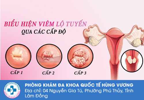 Nguyên nhân ra dịch âm đạo đen là do đâu?