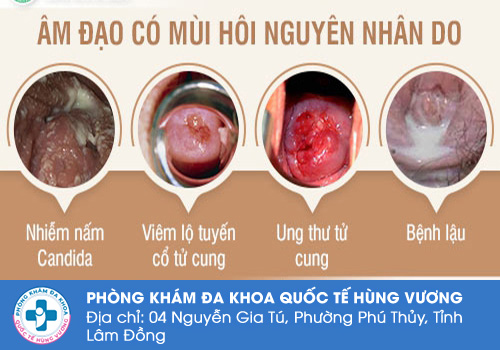 Nguyên nhân gây ra tình trạng hôi vùng kín là gì?