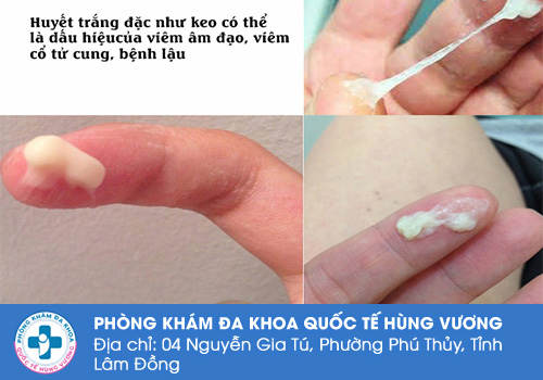 Ra khí hư màu trắng đục là bị gì?