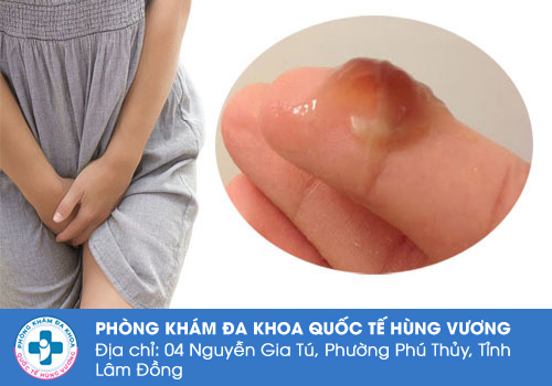 Chua âm đạo biểu hiện của những bệnh lý gì?