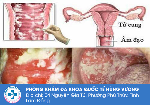 Dịch âm đạo màu trắng sữa có sao không?
