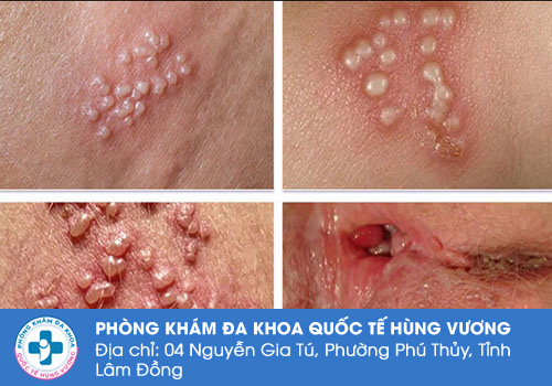 Có điều trị Virus Herps dứt điểm được không?